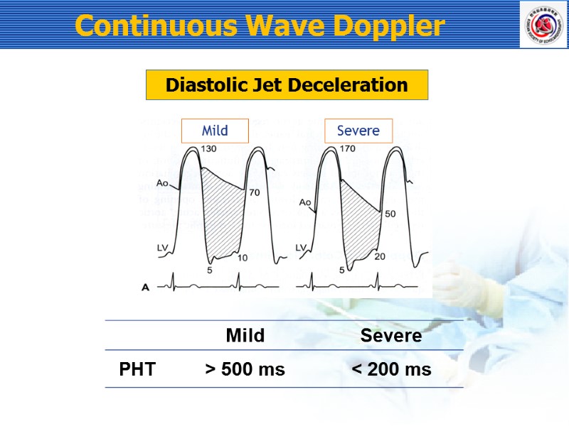 Continuous Wave Doppler Mild Severe Diastolic Jet Deceleration